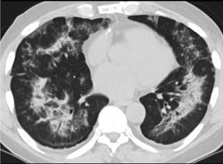 6�����S��CTƽ�߈D���@ʾë����Ӱ׃�錍׃���p�ȽY��Ť����(ͬһ����CTӰ��)